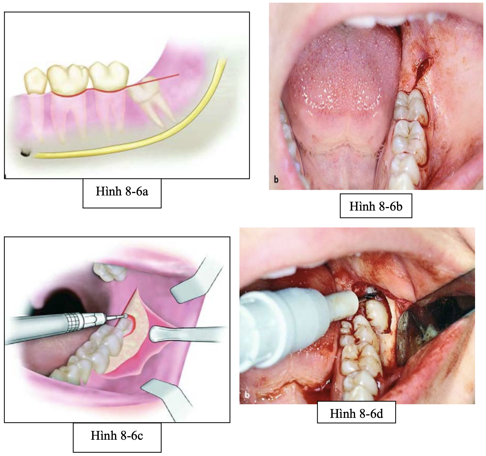 Tiểu phẫu R8 nghiêng gần